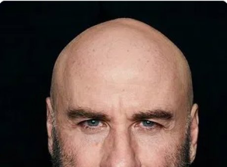 Celebrities wearing hair systems due to hair loss 