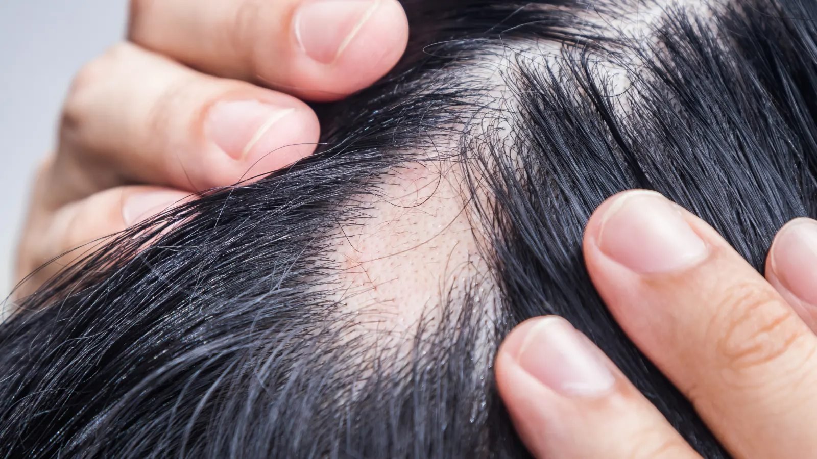 Man’s Alopecia Areata