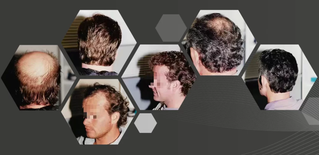 Mature vs. Receding Hairline Choose the Right Wig